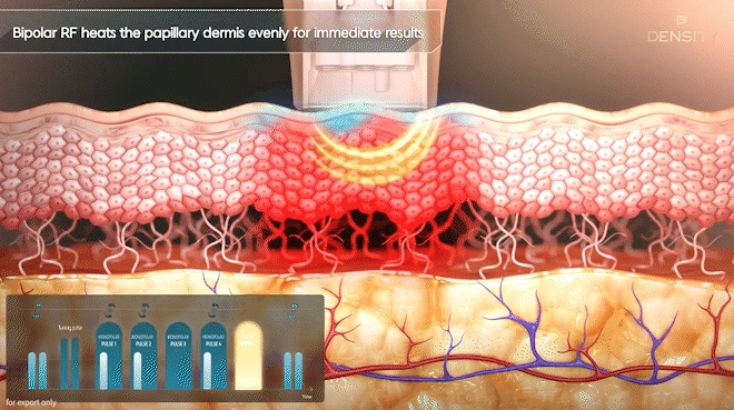 Hongdae Entrance Dermatology Clinic: If You Want to Improve Skin Elasticity image 7