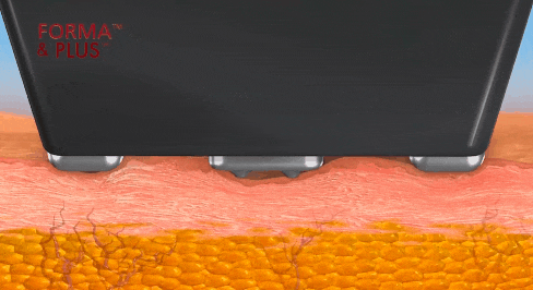 Hongdae InMode: Why the Effects of Forma and FX Must Be Properly Distinguished When Choosing Treatment image 2