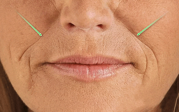 Hongdae Density Lifting: The Core Principles of RF Laser and Firming Effects image 4