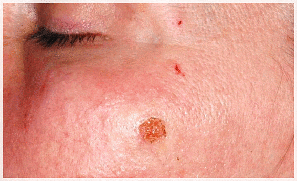 Sinchon Mole Removal: What to Check Before Price or Reviews image 5
