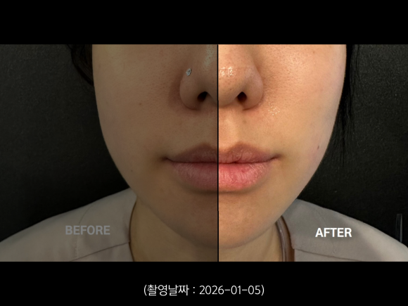 A Case of Improving a Round Jawline with the Tentriple Lift at Sinchon image 3