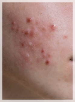 Sinchon Acne Dermatology Clinic, Why It Keeps Recurring Even After Treatment image 2