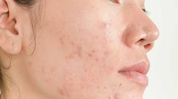 홍대여드름흉터 시술은 어떻게 진행되고, 몇 회 정도 필요할까요? 관련 이미지 7