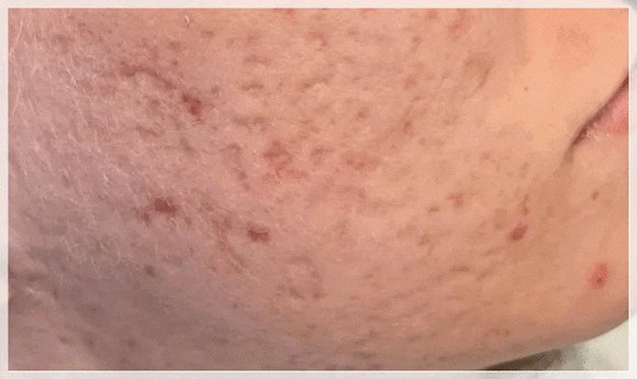 Sinchon Acne Dermatology Clinic: Why Treatment Order Matters image 5