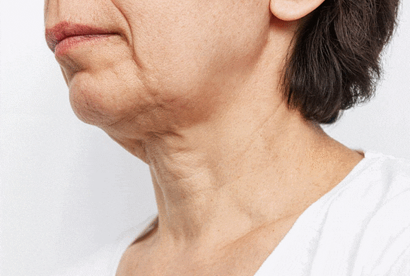 Can Onda Lifting at a Hongdae Dermatology Clinic Improve Nasolabial Folds and Sagging Jawlines? image 8