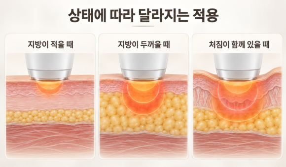 마포 온다리프팅 어떤 시술일까? 효과부터 부작용까지 확인해보세요. 관련 이미지 5
