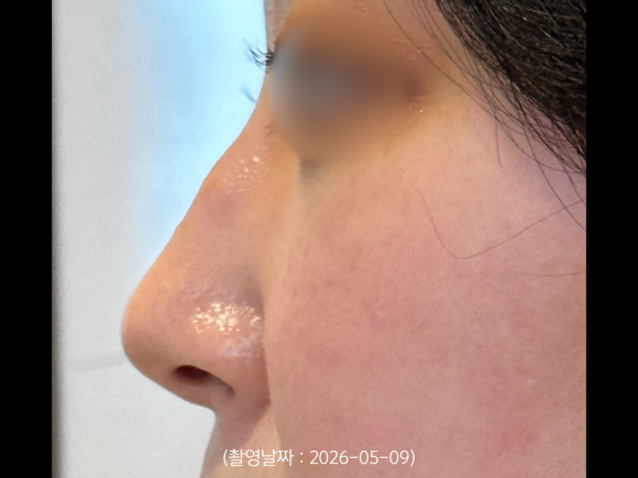 A Case of Correcting a Hump Nose with HiCo Thread Lifting in Hongdae image 2