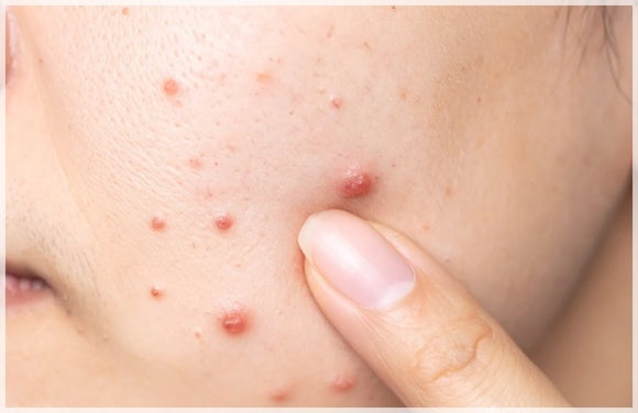 Dermatology Clinic Near Hongik Univ. Station: Which Treatments Are Recommended for College Students? image 3