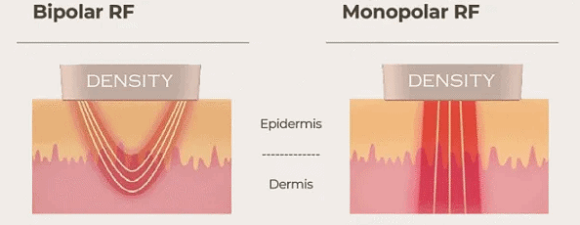 Hongdae Density Lifting: The Core Principles of RF Laser and Firming Effects image 3