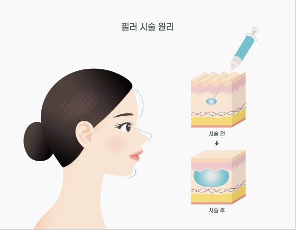 홍대입구역 필러 부위별 만족도를 높이려면? 관련 이미지 3