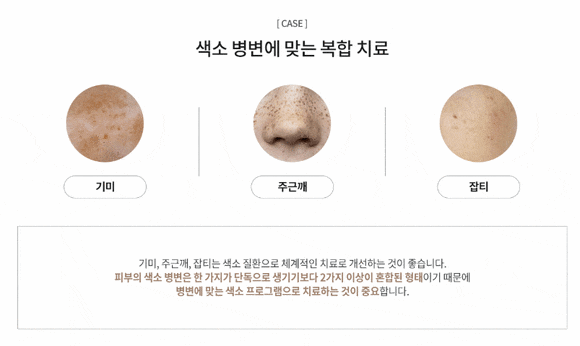 홍대피부과추천 기미&middot;잡티 치료 자극 없이 오래가려면 관련 이미지 2