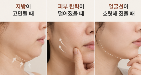 마포 온다리프팅 어떤 시술일까? 효과부터 부작용까지 확인해보세요. 관련 이미지 4