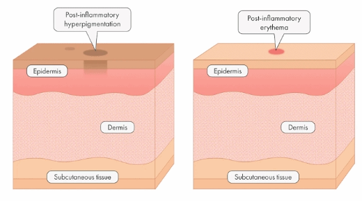 Sinchon Acne Scars: How They Are Treated by Type image 5