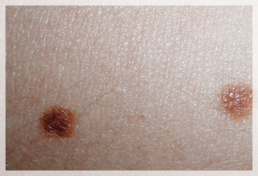 Hongdae Mole Removal: What to Know Before Having a Mole Removed image 3