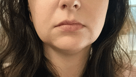 Considering Sinchon InMode or Ultherapy?! image 1