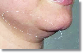 Hongdae ONDA Lifting: Things You Must Know Before the Procedure image 1