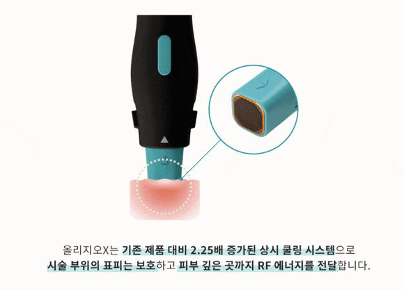 올리지오X 차이, 울쎄라와 뭐가 다를까? 관련 이미지 6