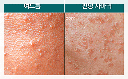 Shinchon Flat Warts May Spread If Simply Removed image 3