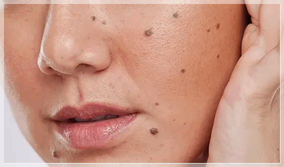Sinchon Mole Removal: What to Check Before Price or Reviews image 4