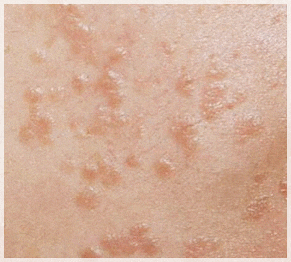 Why Flat Warts in Sinchon Keep Spreading to the Surrounding Area image 1