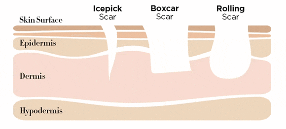 Hongdae Acne Dermatology: Can You Recover Smooth Skin Without Scarring? image 2