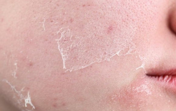 Sinchon Rejuran: Are the Effects and Pain Mentioned in Reviews Really True? image 1