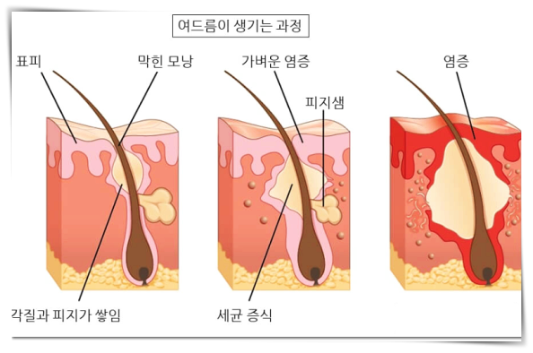 신촌여드름, 흉터되기 전 &lsquo;이렇게&rsquo; 치료하세요 <필독> 관련 이미지 4