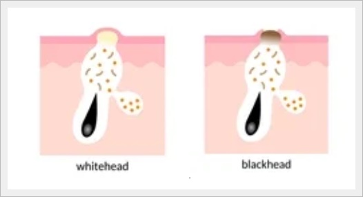 Hongdae Acne Dermatology Clinic: Why You Should First Consider the Stage of Your Acne image 2