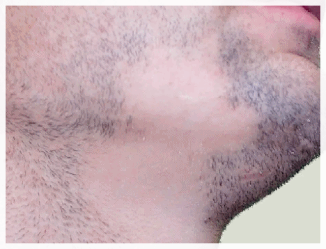 Sinchon Laser Hair Removal: Why a 5-Session Package May Not Be Enough image 7