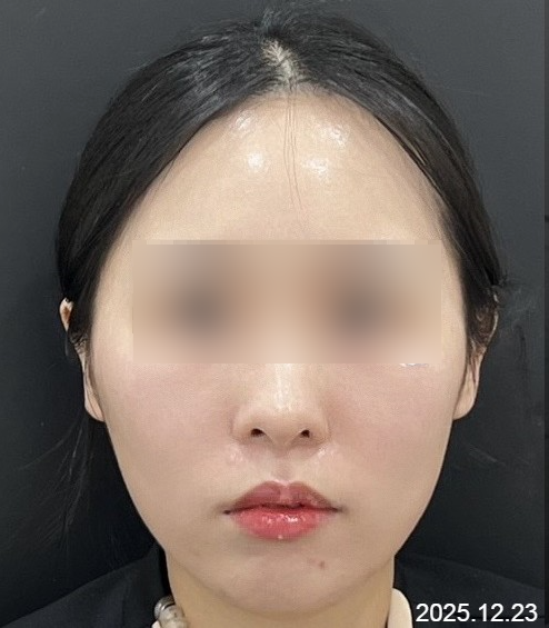 홍대 풀페이스 필러 시술 사례 - 눈 밑, 앞볼, 옆볼, 입술, 턱 필러 관련 이미지 1