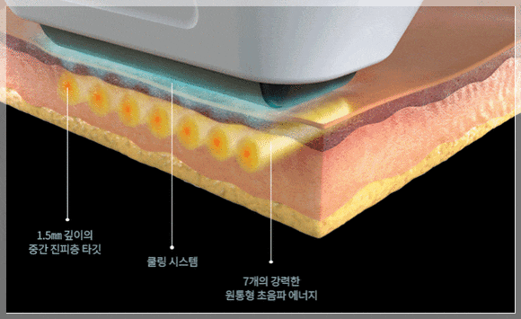 Shinchon Station Dermatology Clinic: How Sofwave Differs from Conventional Ultrasound Lifting image 5