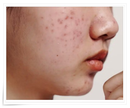신촌여드름압출, 후기들처럼 정말 좋아질 수 있을까? 관련 이미지 6