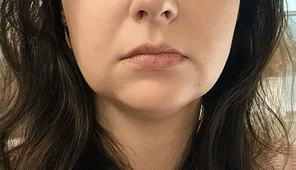 Can Onda Lifting at a Hongdae Dermatology Clinic Improve Nasolabial Folds and Sagging Jawlines? image 6
