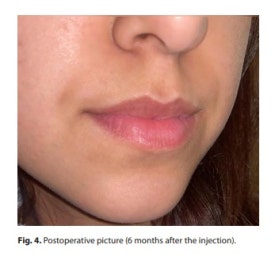 What Effects Can You Expect from Lip Rejuran? image 6