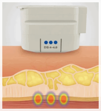 Hongdae Sofwave: How Does It Differ from the Effects of Ultherapy? image 4