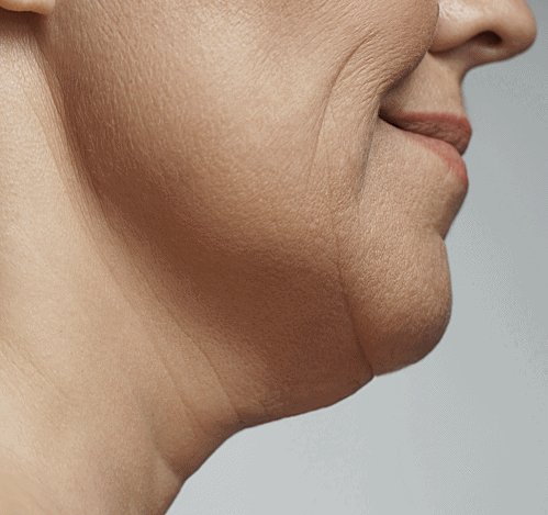 Can Onda Lifting at a Hongdae Dermatology Clinic Improve Nasolabial Folds and Sagging Jawlines? image 3