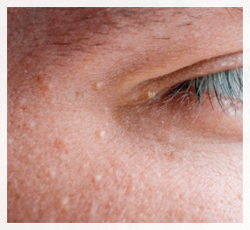 Why Flat Warts in Sinchon Keep Spreading to the Surrounding Area image 2