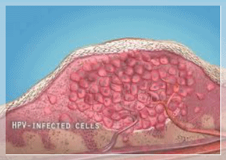 Why Flat Warts in Sinchon Keep Spreading to the Surrounding Area image 5