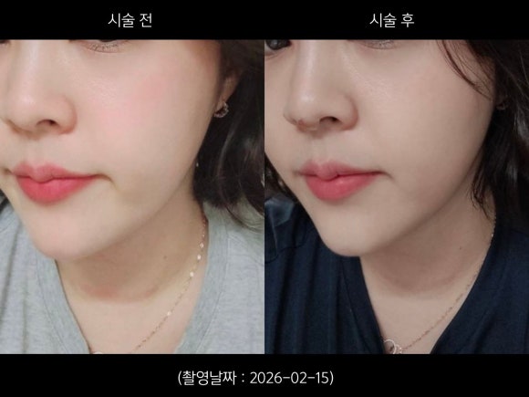 Hongdae Hiko Nose Thread Lifting Procedure Case image 3