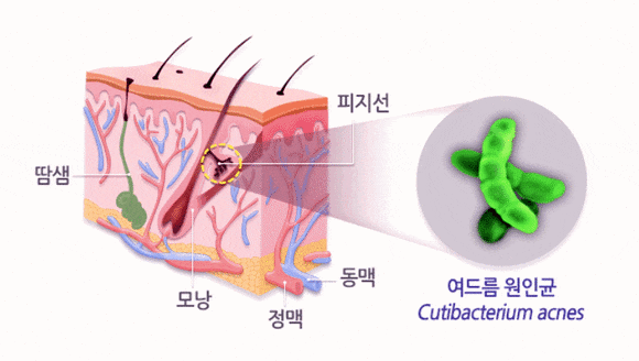 Why does acne keep recurring even after treatment at a Sinchon acne dermatology clinic? image 2