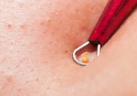Hongdae Acne Extraction: 3 Things You Must Check image 4