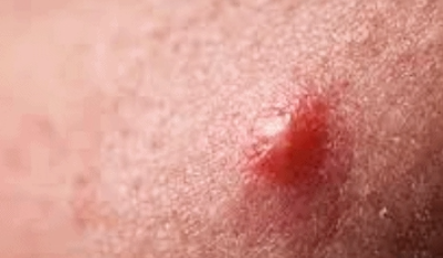 홍대여드름치료, 반복적인 재발 막기 위한 루틴 3가지 관련 이미지 1