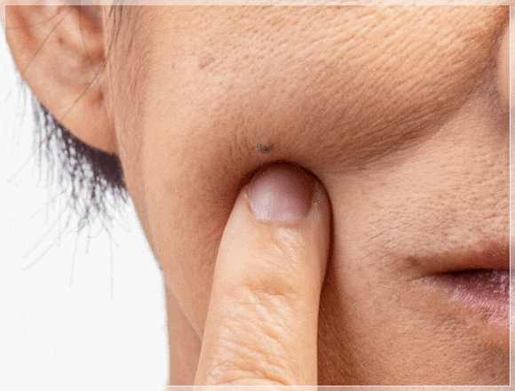Recommended Dermatology Treatments in Shinchon That Vary Depending on the Pattern of Loss of Skin Elasticity image 2