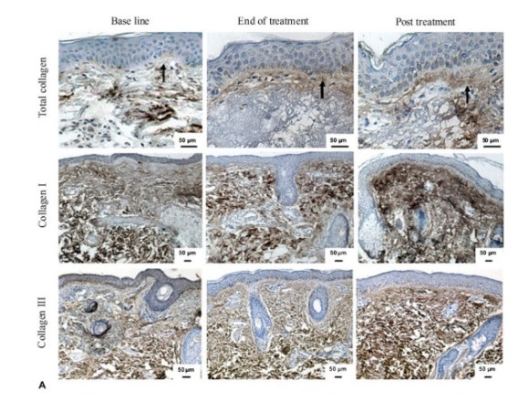 Wondering About the Lifting Effects of Shinchon Thermage? image 4