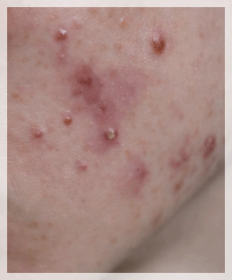 Sinchon Acne Dermatology Clinic, Why It Keeps Recurring Even After Treatment image 3