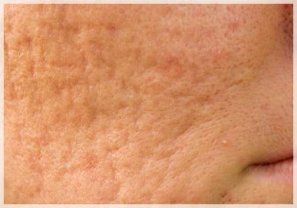 Potenza and Exosome Combination: What Skin Is It Effective For? image 7