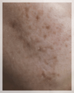 Sinchon Acne Dermatology Clinic, Why It Keeps Recurring Even After Treatment image 8