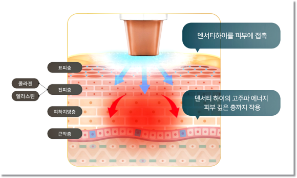 울쎄라 + 덴서티 하이 리프팅, 후기 믿어도 될까? 관련 이미지 5
