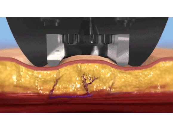 Considering Sinchon InMode or Ultherapy?! image 3