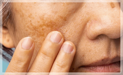 Sinchon Dermatology Clinic, Features and Effects of Different Pigmentation Treatment Devices image 5